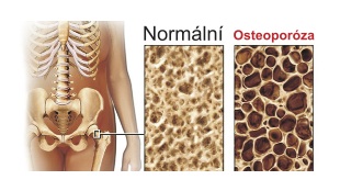 Vývoj osteoporózy